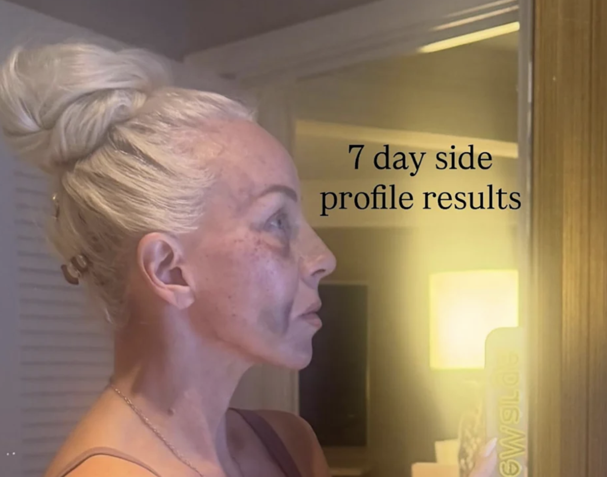 Margaret Josephs Shows Off Bruised Post-Op Photos After Getting a Nose Job